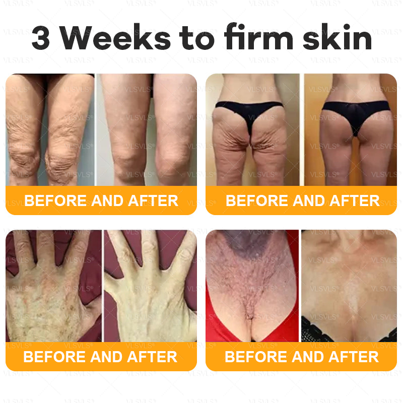 Made and Shipped from USA ✨ VLSVLS® Bee Venom Skin Restoration Cream 🌸 Anti-aging,Hydrating, Skin Repair, Even Tone, Acne and Dark Spot Treatment, Wart and Mole Removal, Psoriasis Relief CS 🔥 LAST DAY 80% OFF 💎