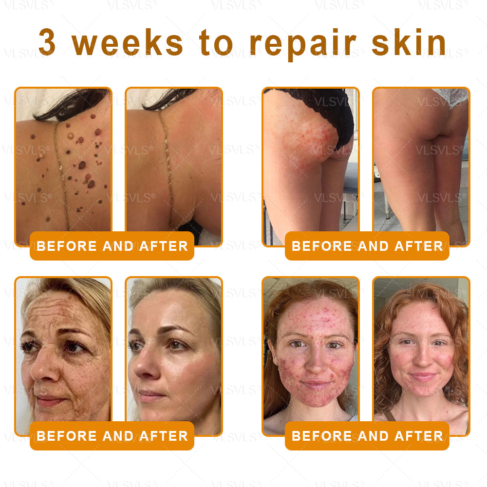 Made and Shipped from USA ✨ VLSVLS® Bee Venom Skin Restoration Cream 🌸 Anti-aging,Hydrating, Skin Repair, Even Tone, Acne and Dark Spot Treatment, Wart and Mole Removal, Psoriasis Relief CS 🔥 LAST DAY 80% OFF 💎